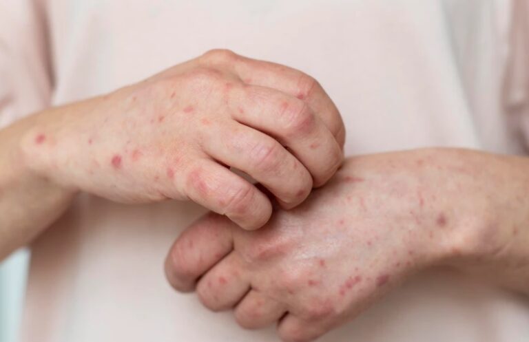 WHO Signals Sharp Rise in Measles Cases in Europe