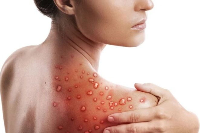 Sweden records first case of so-called monkeypox outside of Africa